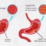 Several of SKN’s adults and children diagnosed with Acute Gastroenteritis, MOH-St. Kitts says