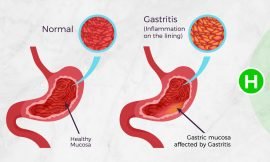 Several of SKN’s adults and children diagnosed with Acute Gastroenteritis, MOH-St. Kitts says