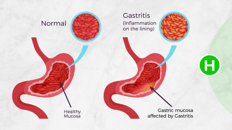 Read more about the article Several of SKN’s adults and children diagnosed with Acute Gastroenteritis, MOH-St. Kitts says