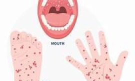 Federal Ministry of Health issues alert on reported cases of HFMD