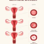 Pap Smear Outreach Set for Saturday across Nevis Health Centers